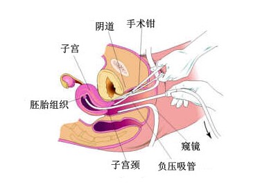 打胎需要多少费用